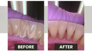 dental hygiene, teeth cleaning