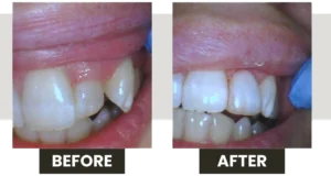 teeth whitening, veneers